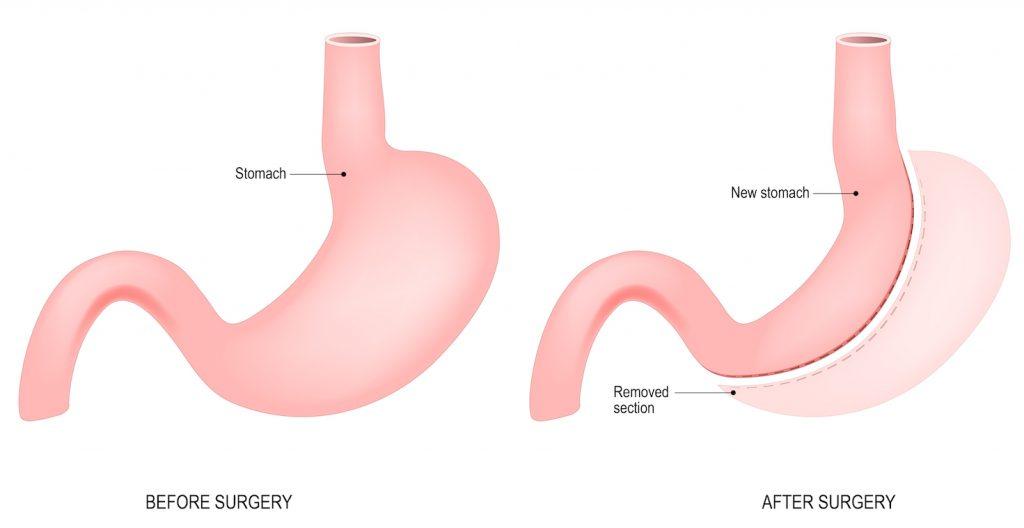 Gastric Sleeve Surgery - Longstreet Clinic Center for Weight Management