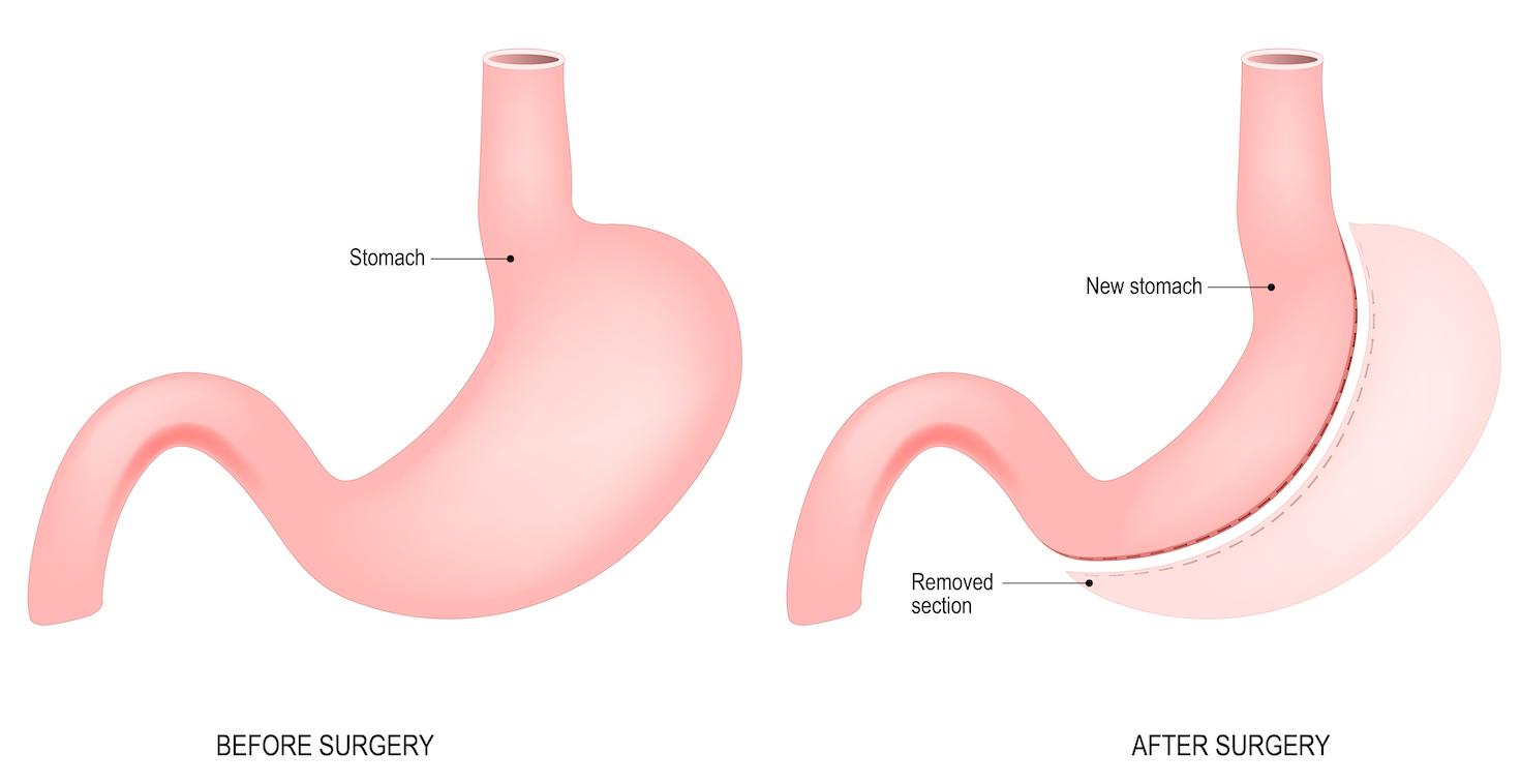 Gastric Sleeve Surgery Longstreet Clinic Center For Weight Management