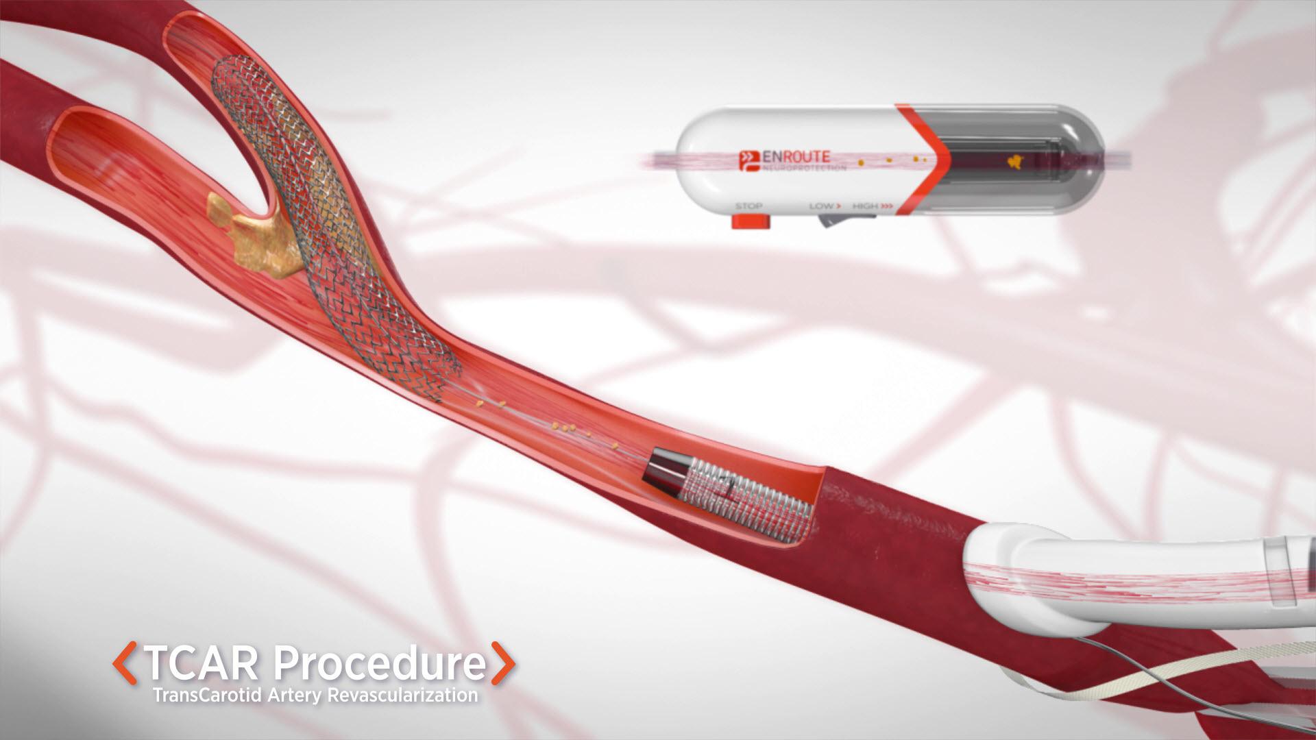 TransCarotid Artery Revascularization - Longstreet Clinic